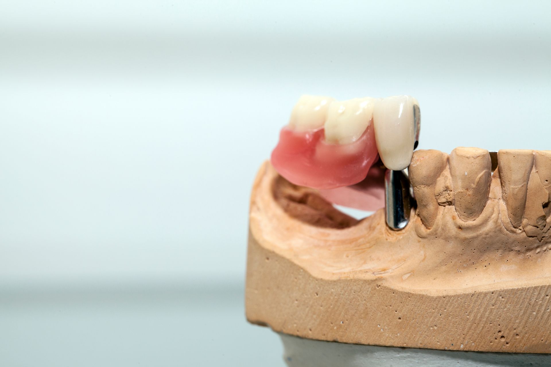 dental implant and denture