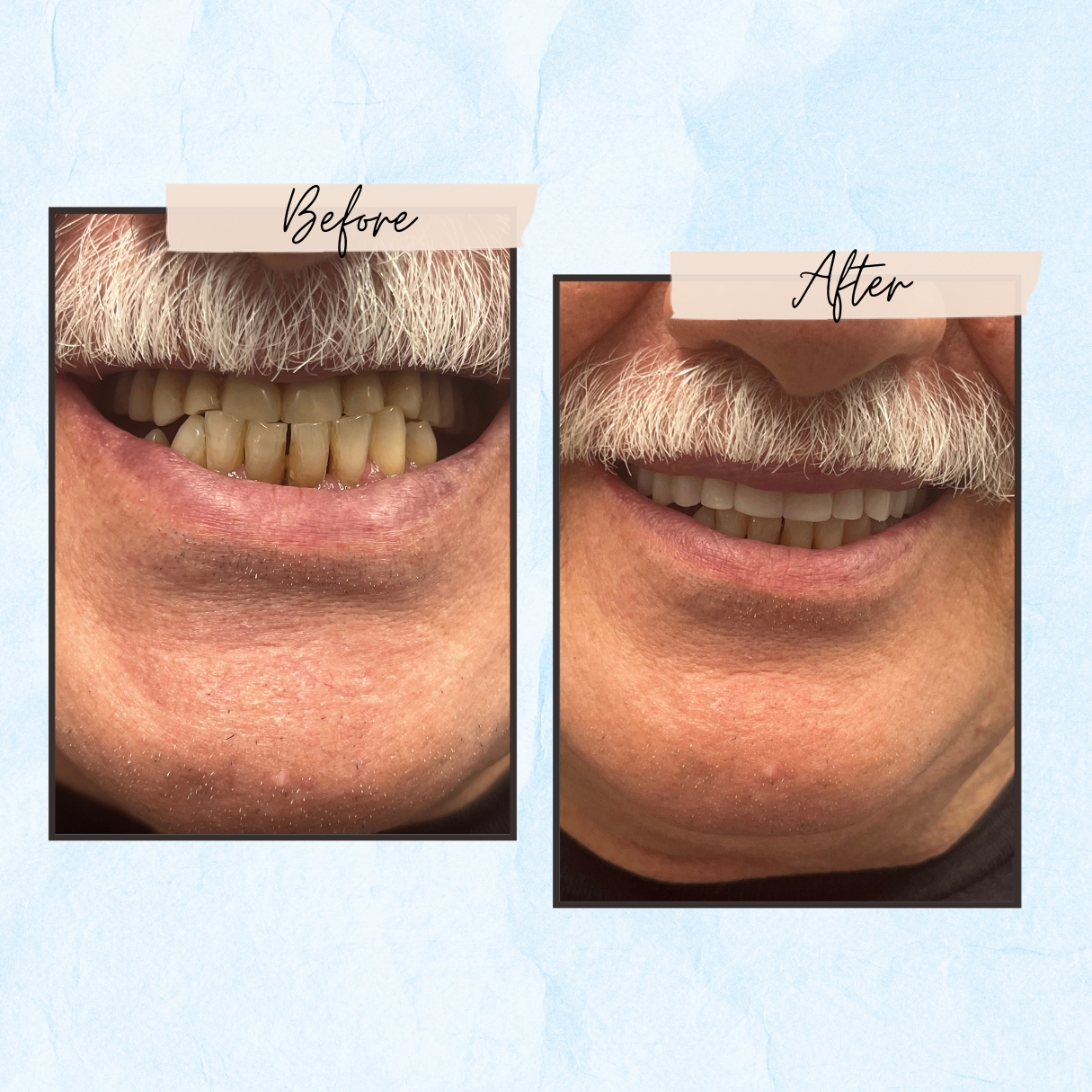 A before and after picture of a man 's teeth