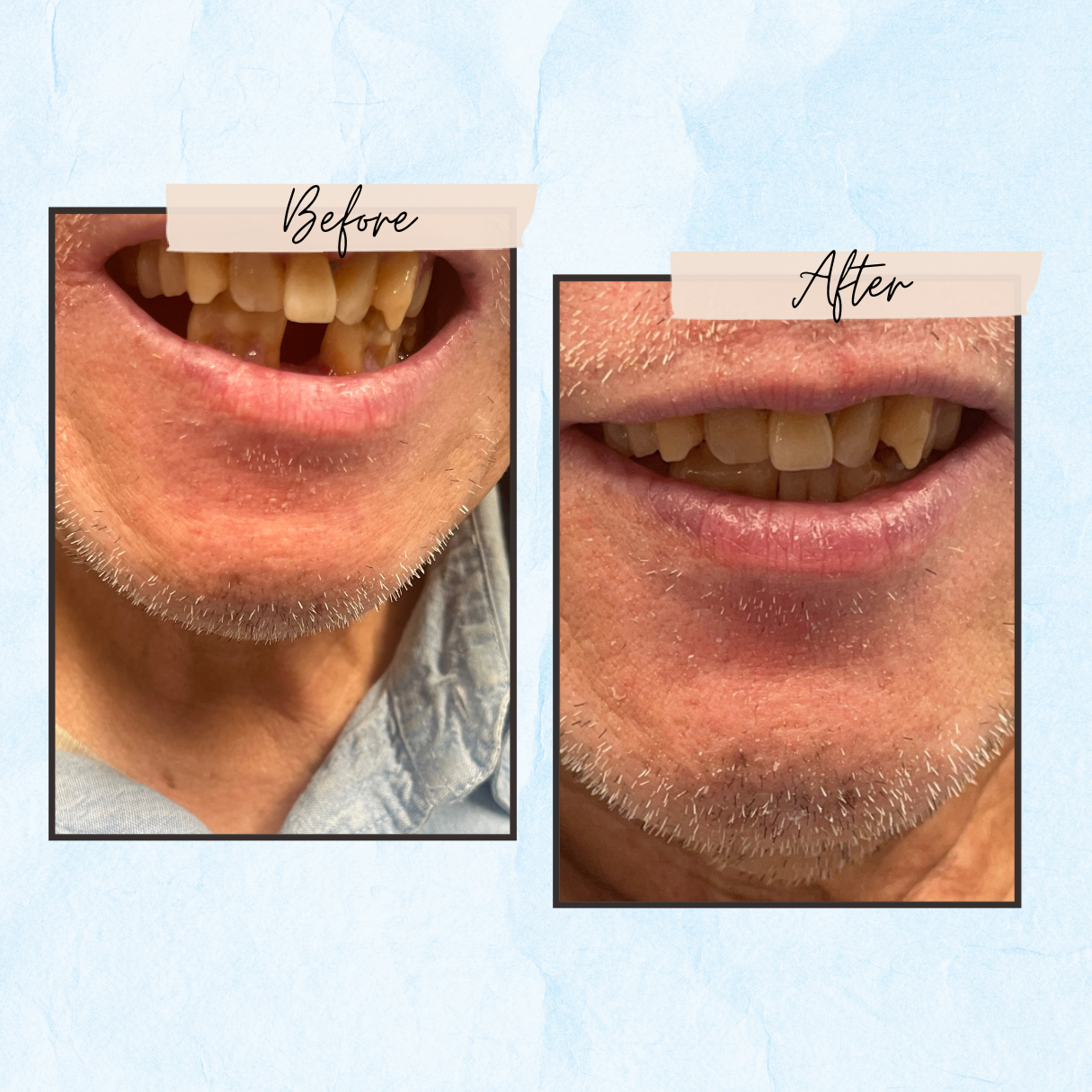 A before and after picture of a man 's teeth