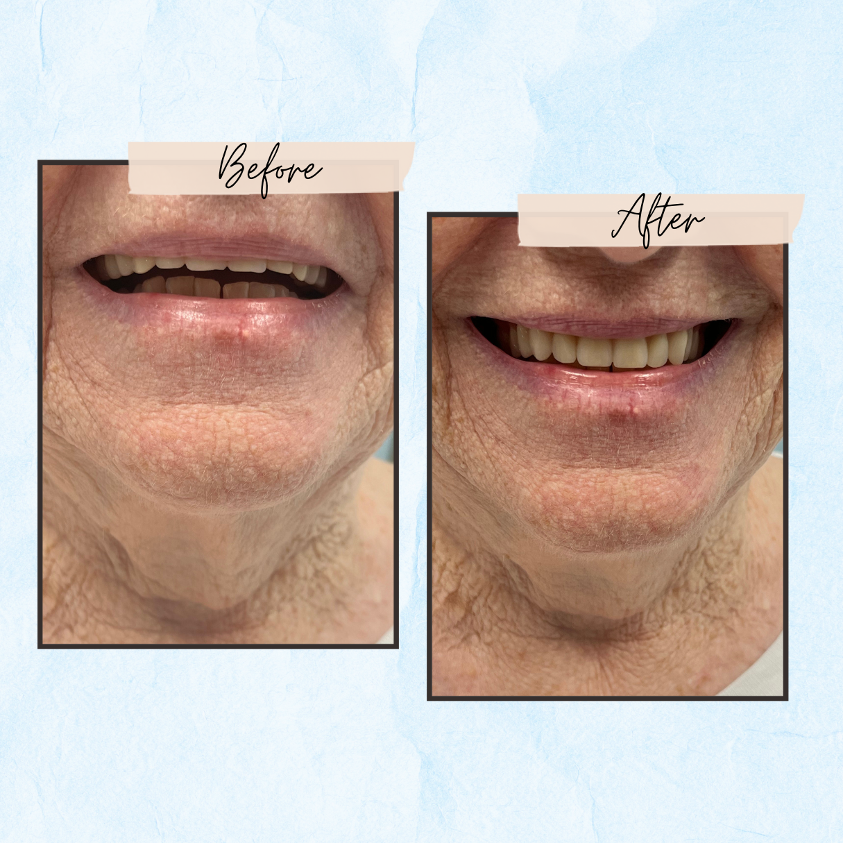 A before and after photo of a woman 's mouth
