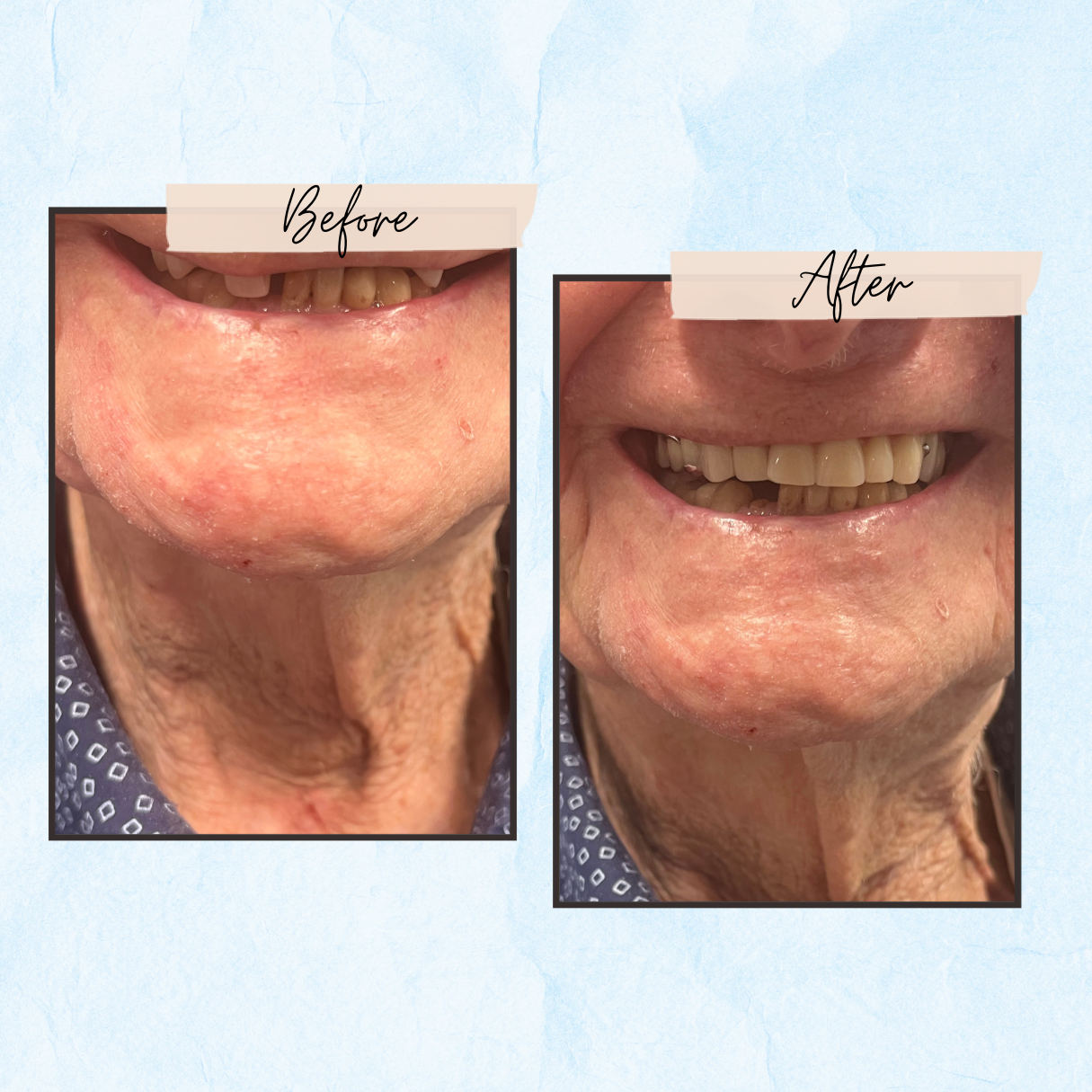 A before and after picture of a woman 's smile