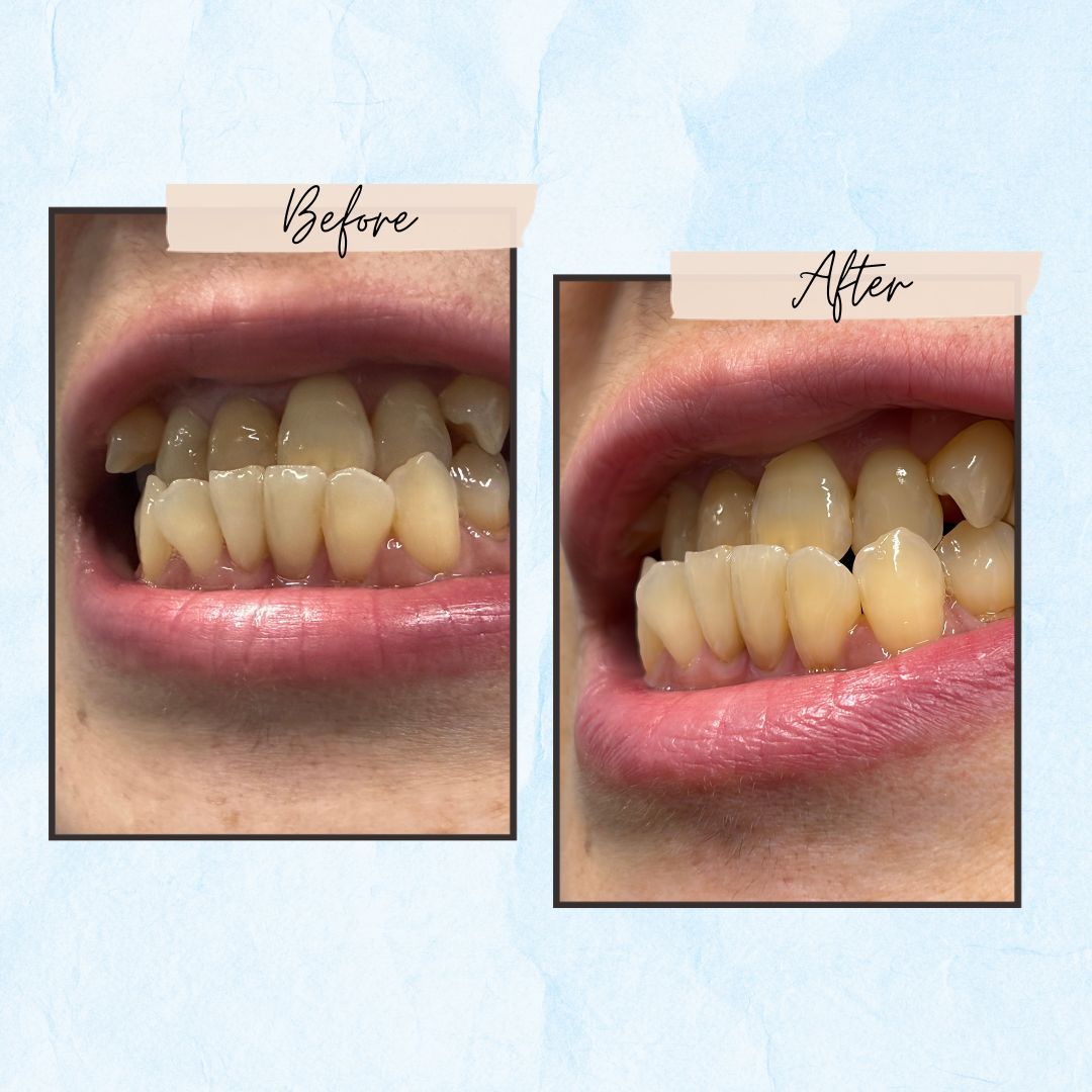 Before and After Gallery - Mountview Denture Clinic