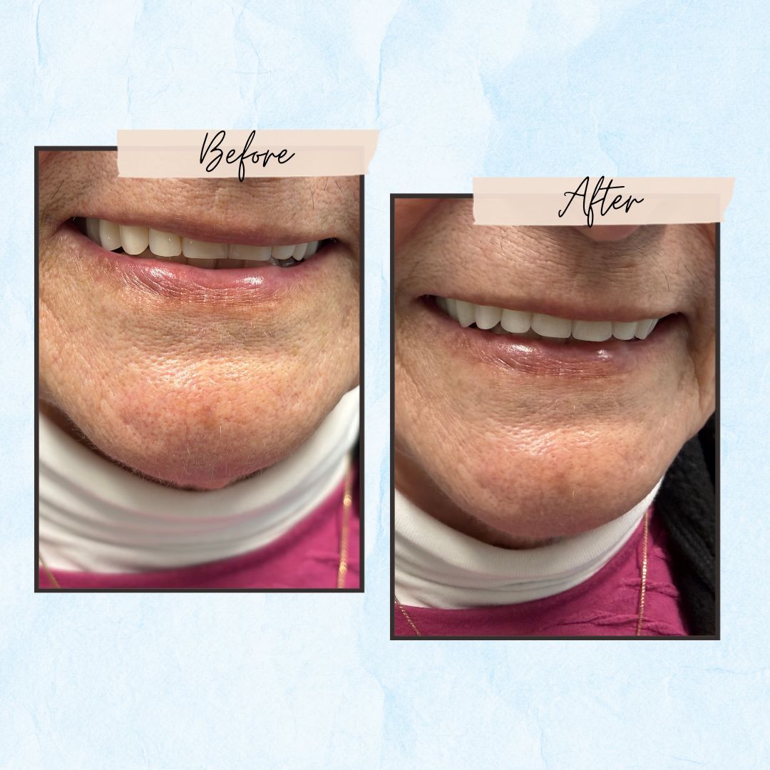 Before and After Gallery - Mountview Denture Clinic
