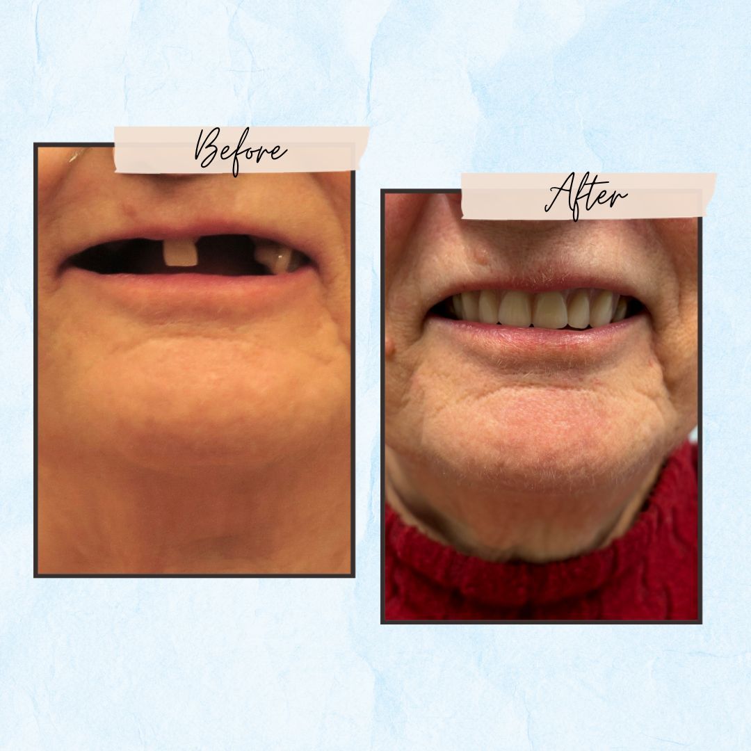 Before and After Gallery - Mountview Denture Clinic