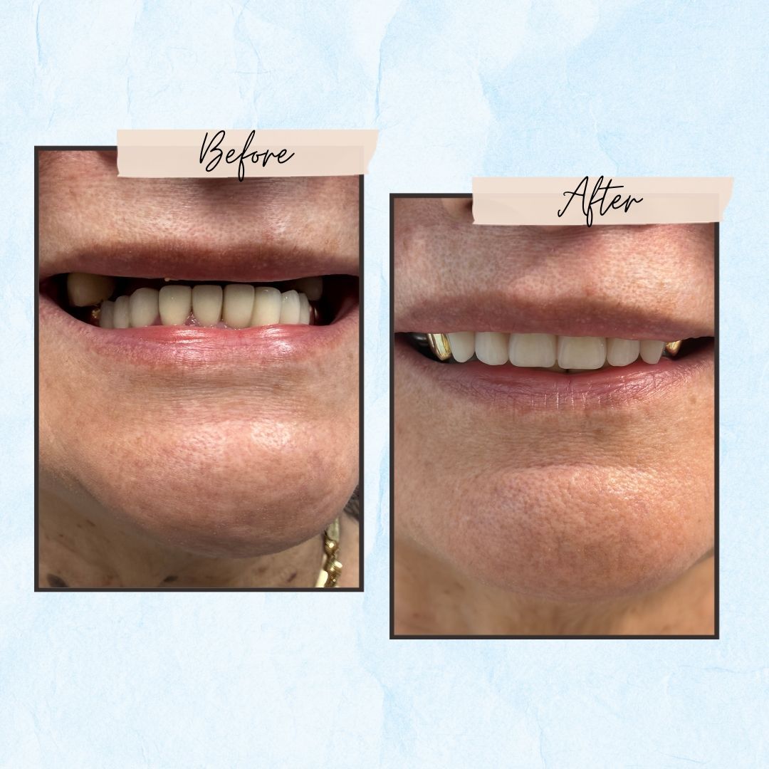 Before-and-after close-up of a mouth, showing improved teeth alignment and a brighter smile.