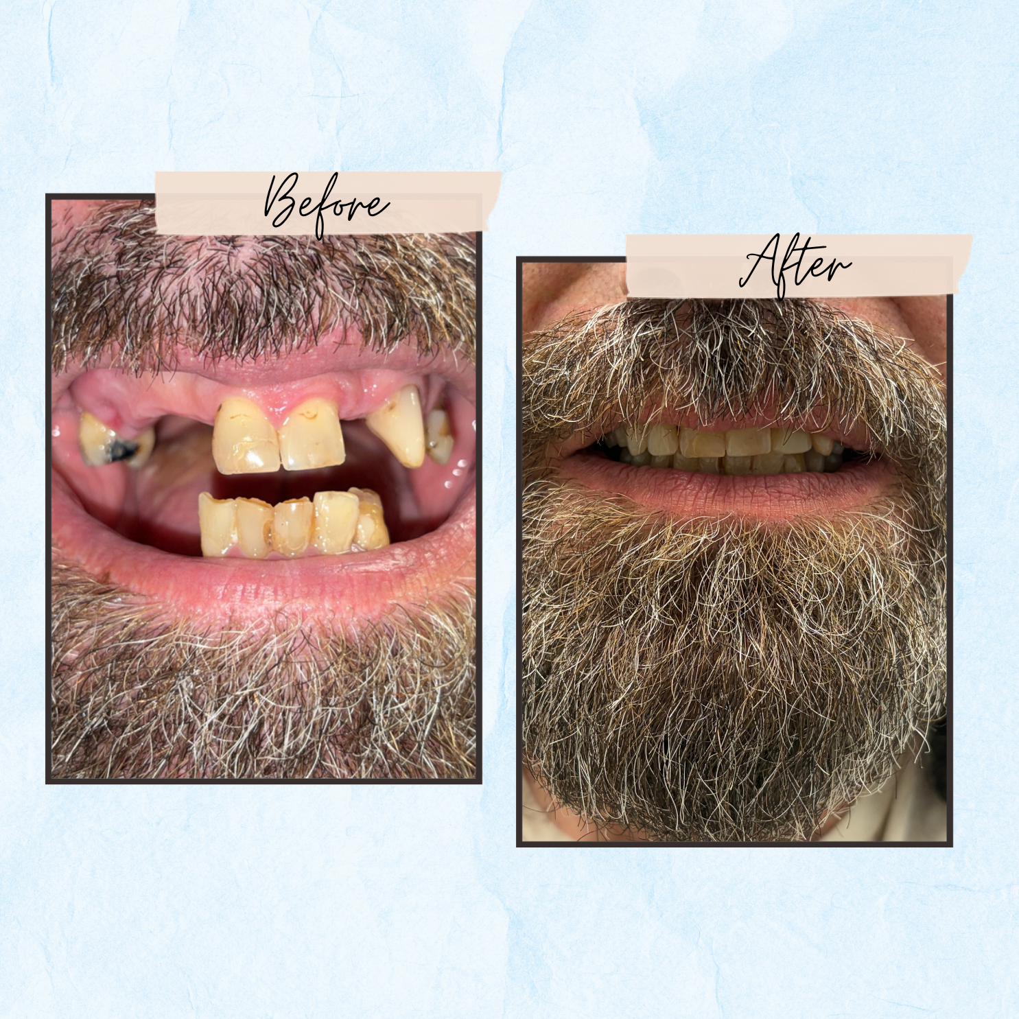 Before and After Gallery - Mountview Denture Clinic