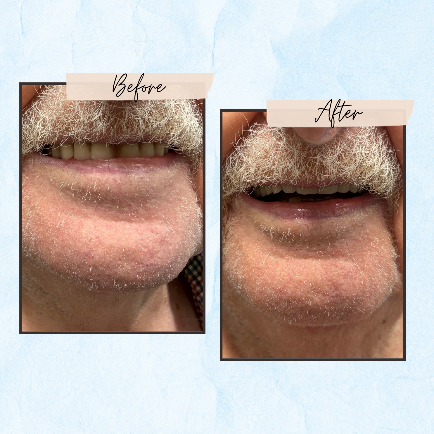 Before and After Gallery - Mountview Denture Clinic