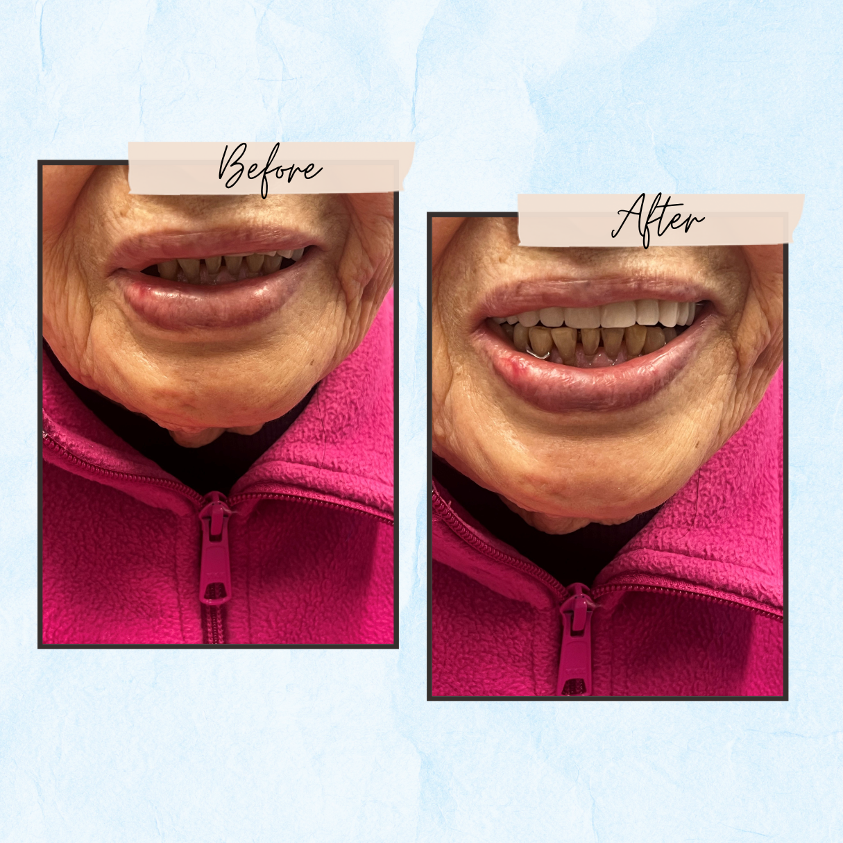 A before and after photo of an elderly woman 's smile