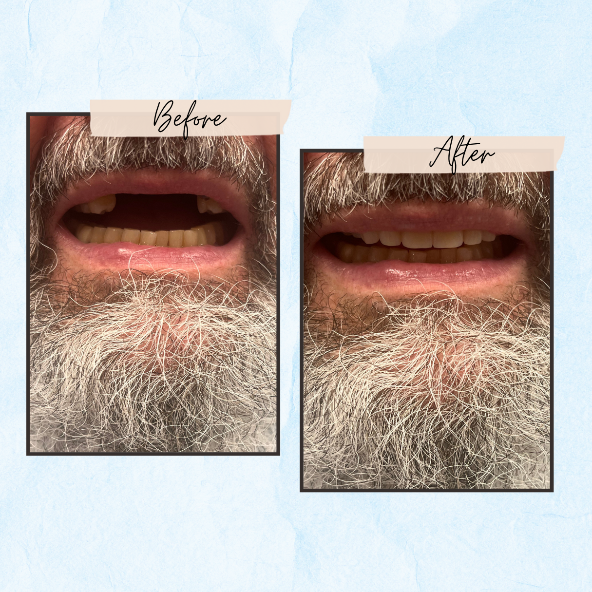 A man with a beard is shown before and after dental treatment.