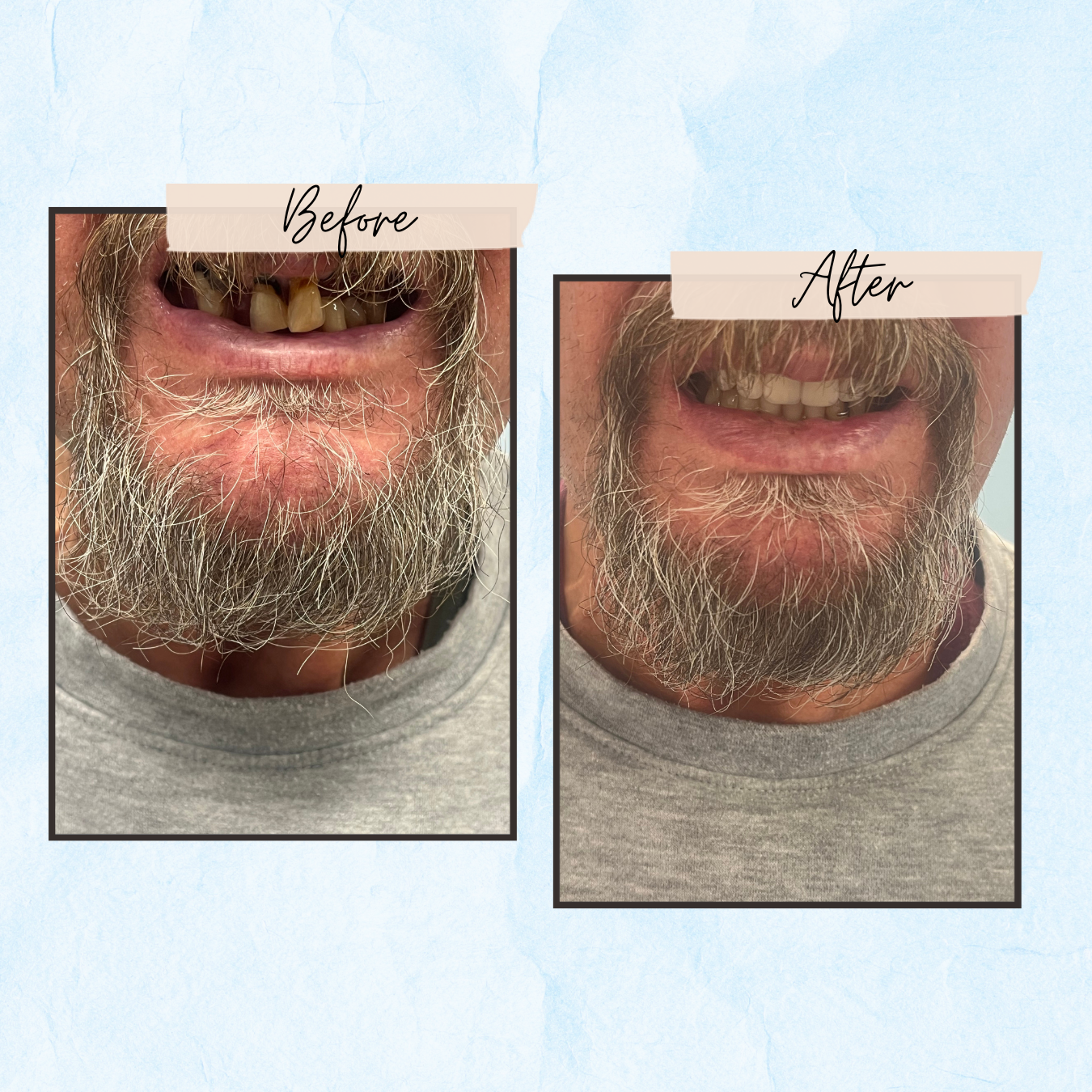 A before and after photo of a man with a beard and missing teeth.