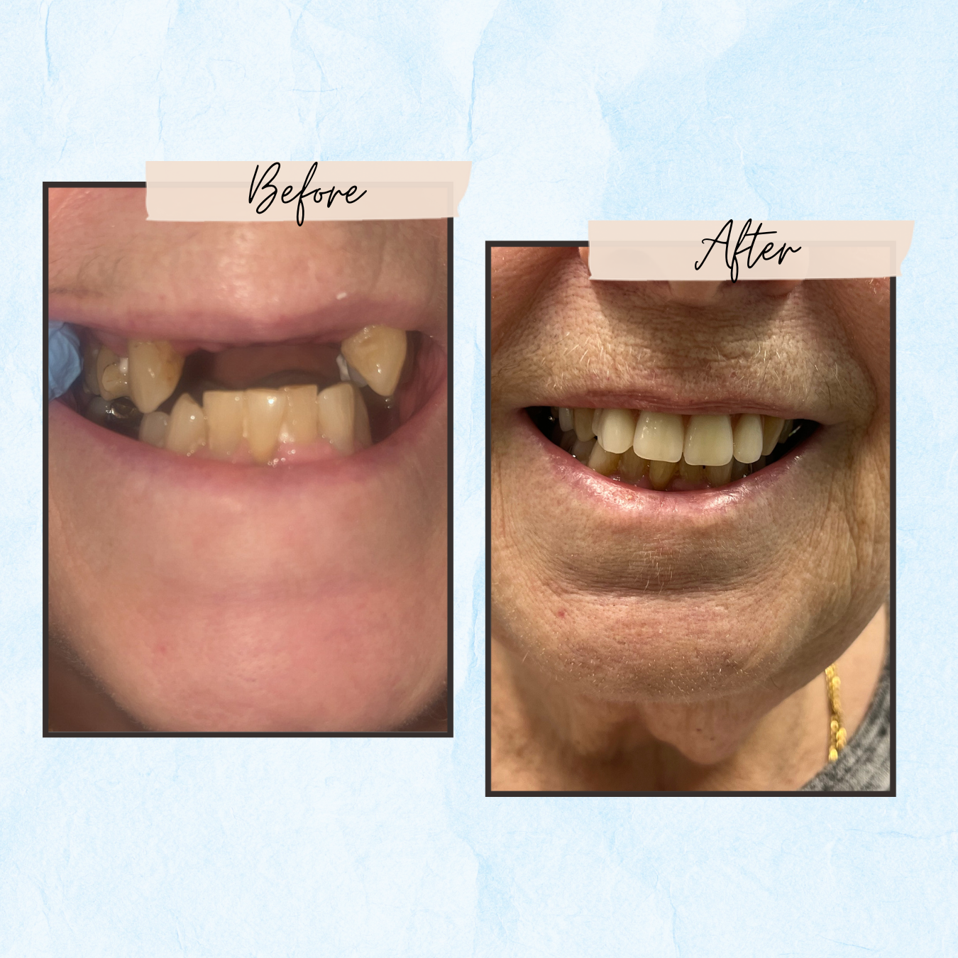 A before and after picture of a woman 's teeth