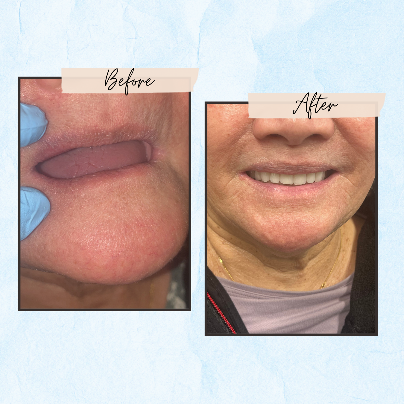 A before and after photo of a woman 's mouth
