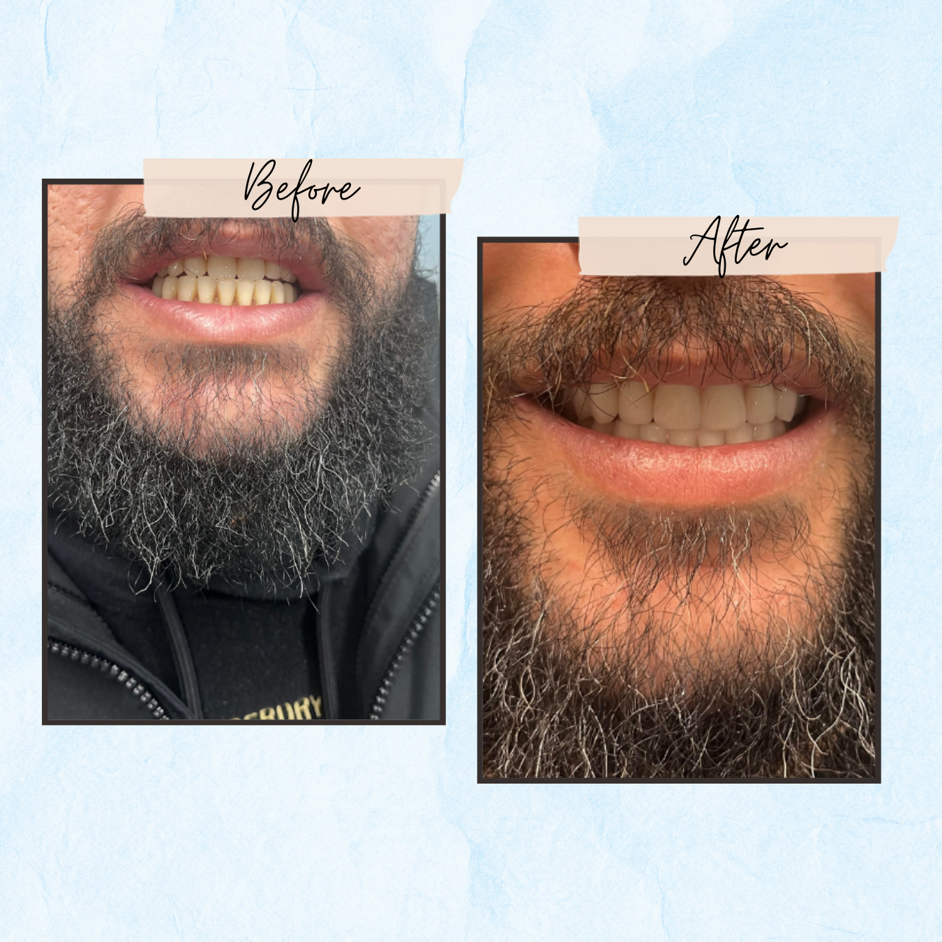 A before and after picture of a man with a beard and teeth.