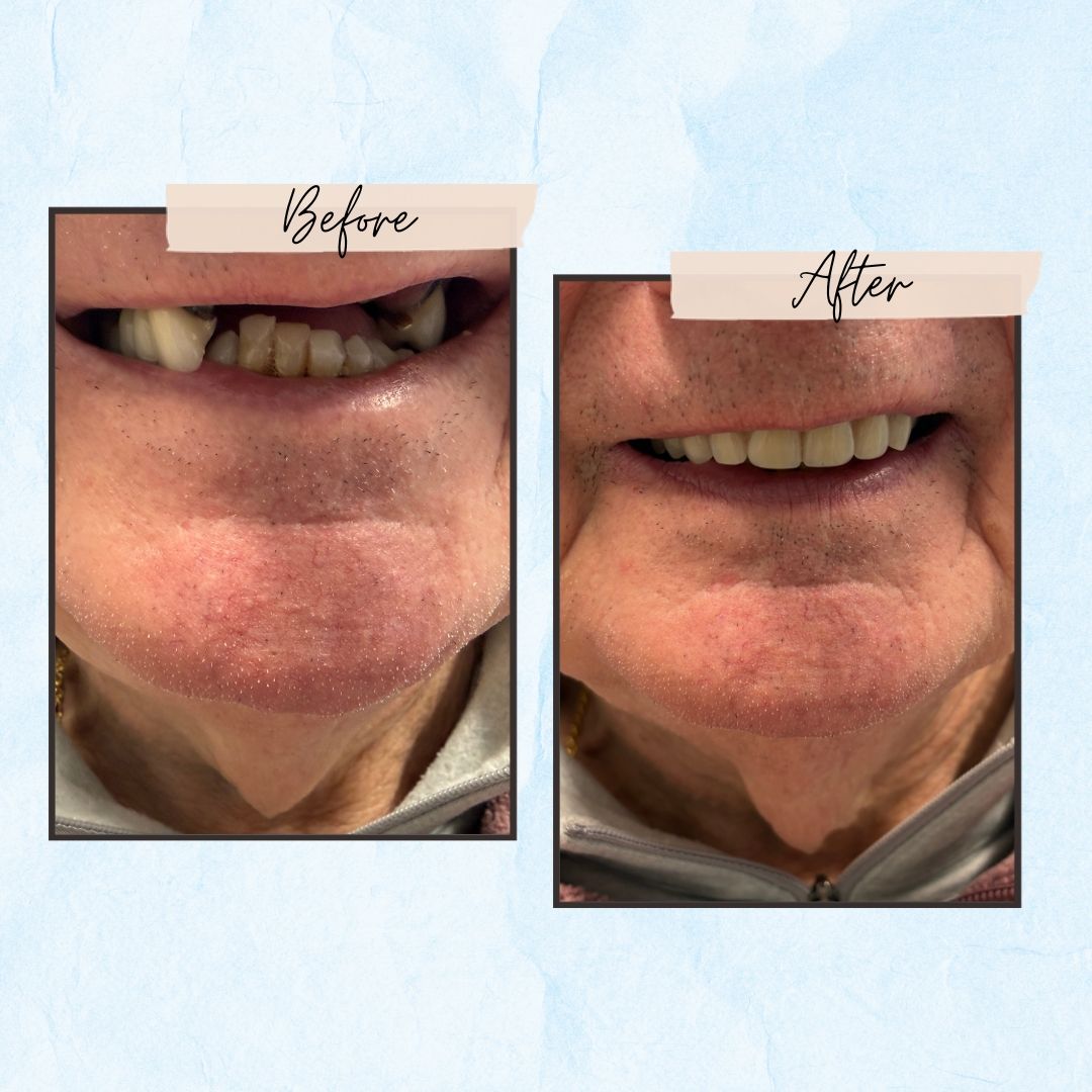 Before and After Gallery - Mountview Denture Clinic
