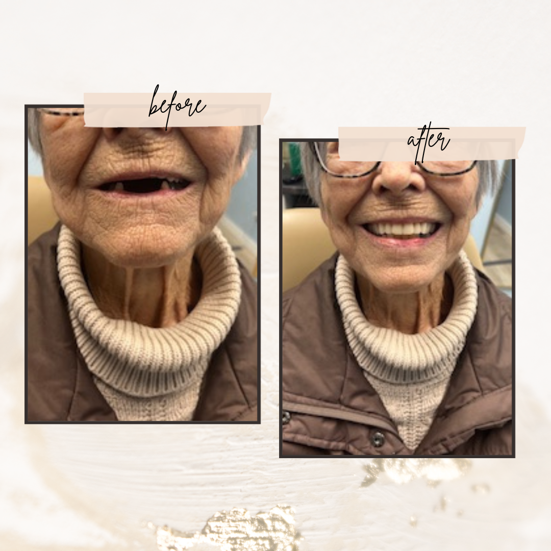 A before and after photo of an elderly woman 's smile.