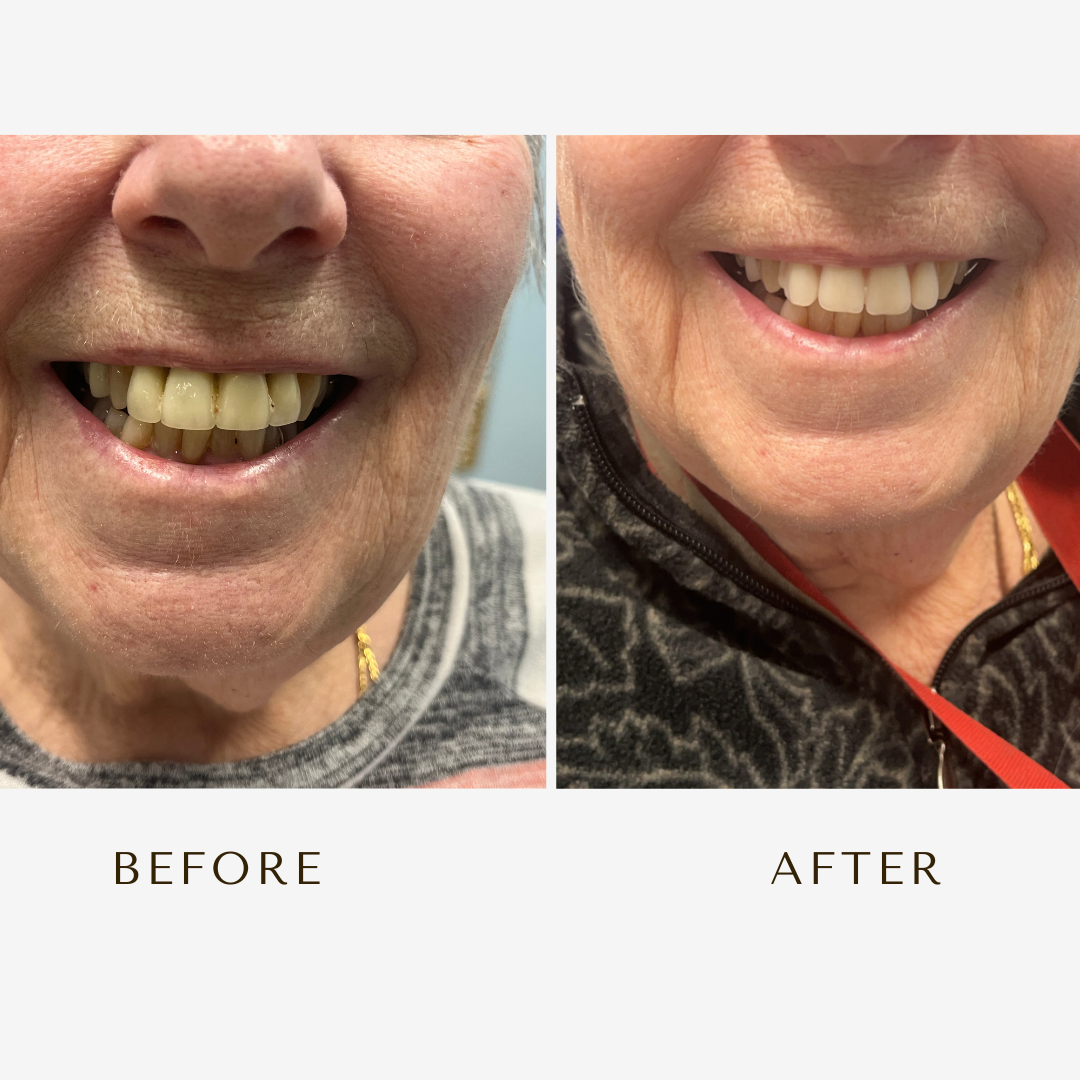 A before and after photo of a woman 's smile