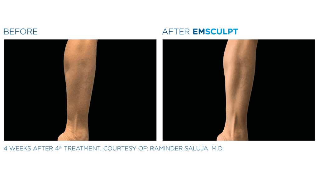before and after EmSculpt for leg