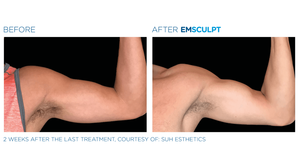 before and after EmSculpt for arm
