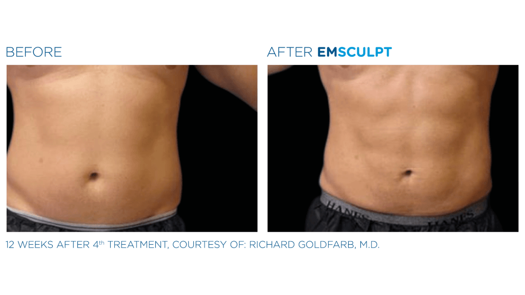 before and after EmSculpt for abdomen