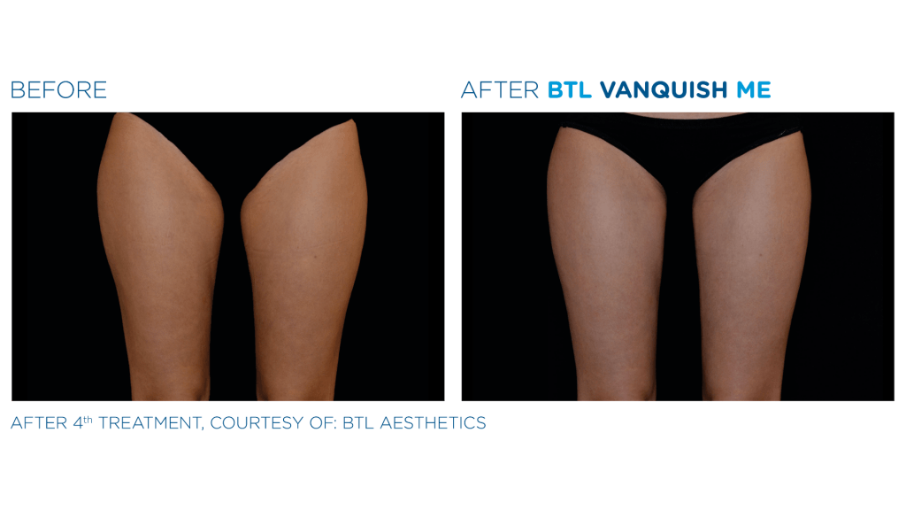 before and after BTL Vanquish Me for thighs