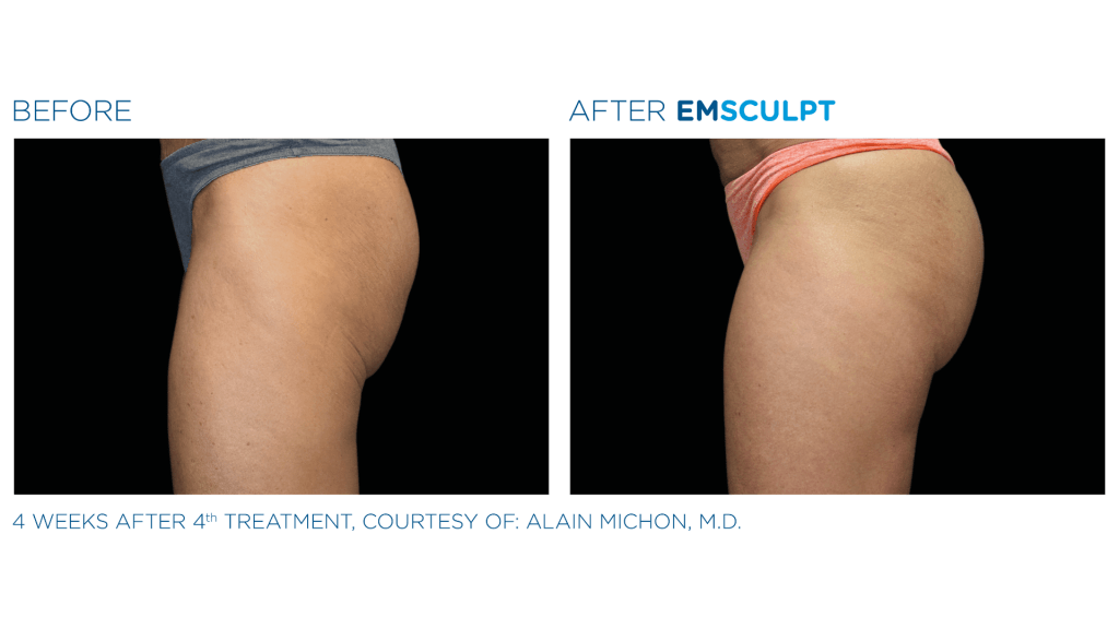 before and after EmSculpt for buttocks