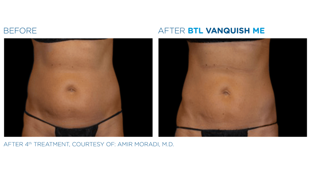 before and after BTL Vanquish Me for abdomen