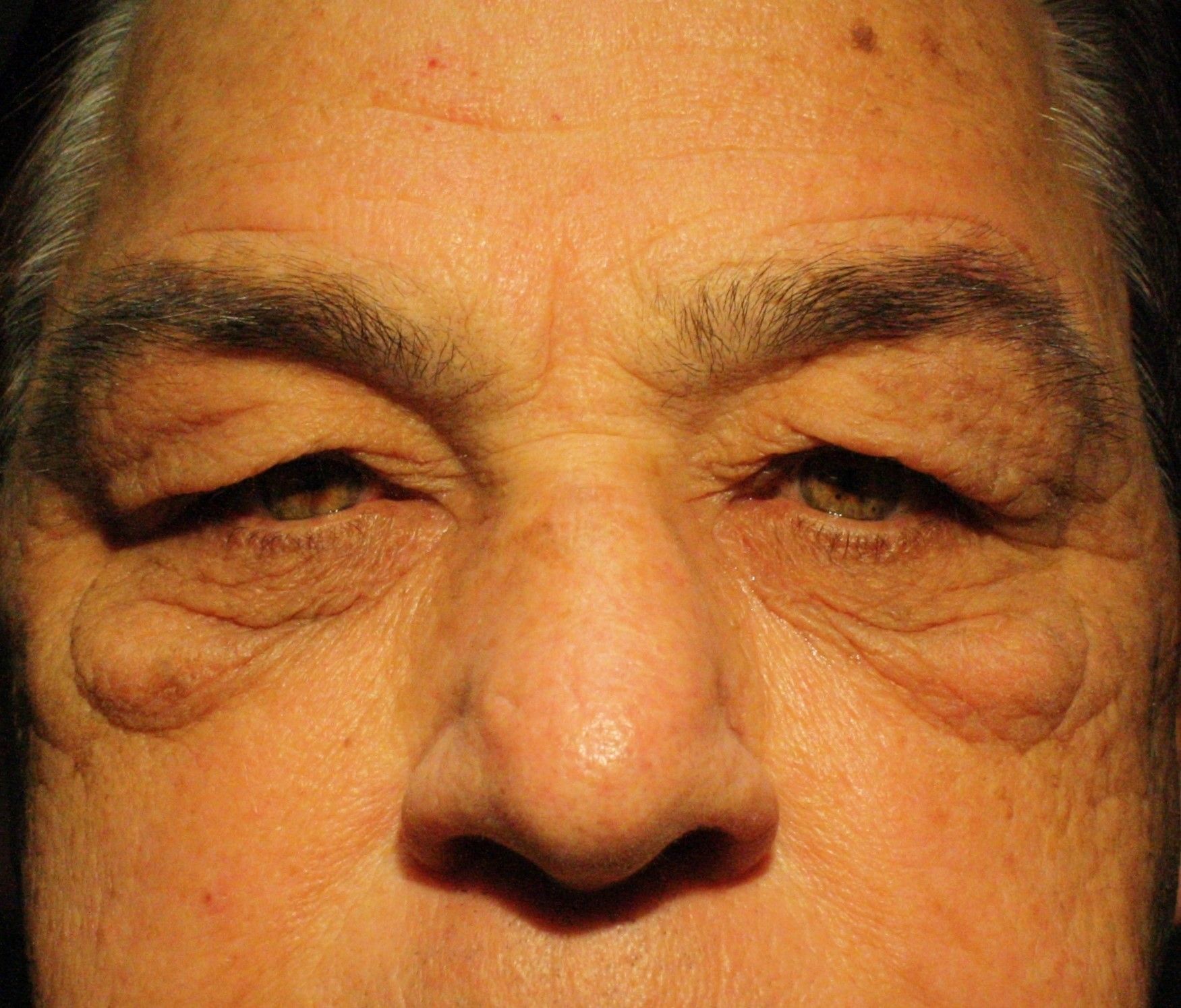 Chirurgie des 4 paupières