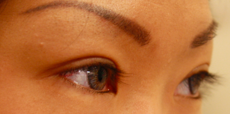 Chirurgie des paupieres asiatiques