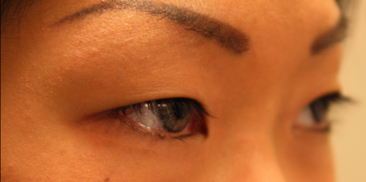 Chirurgie des paupieres asiatiques