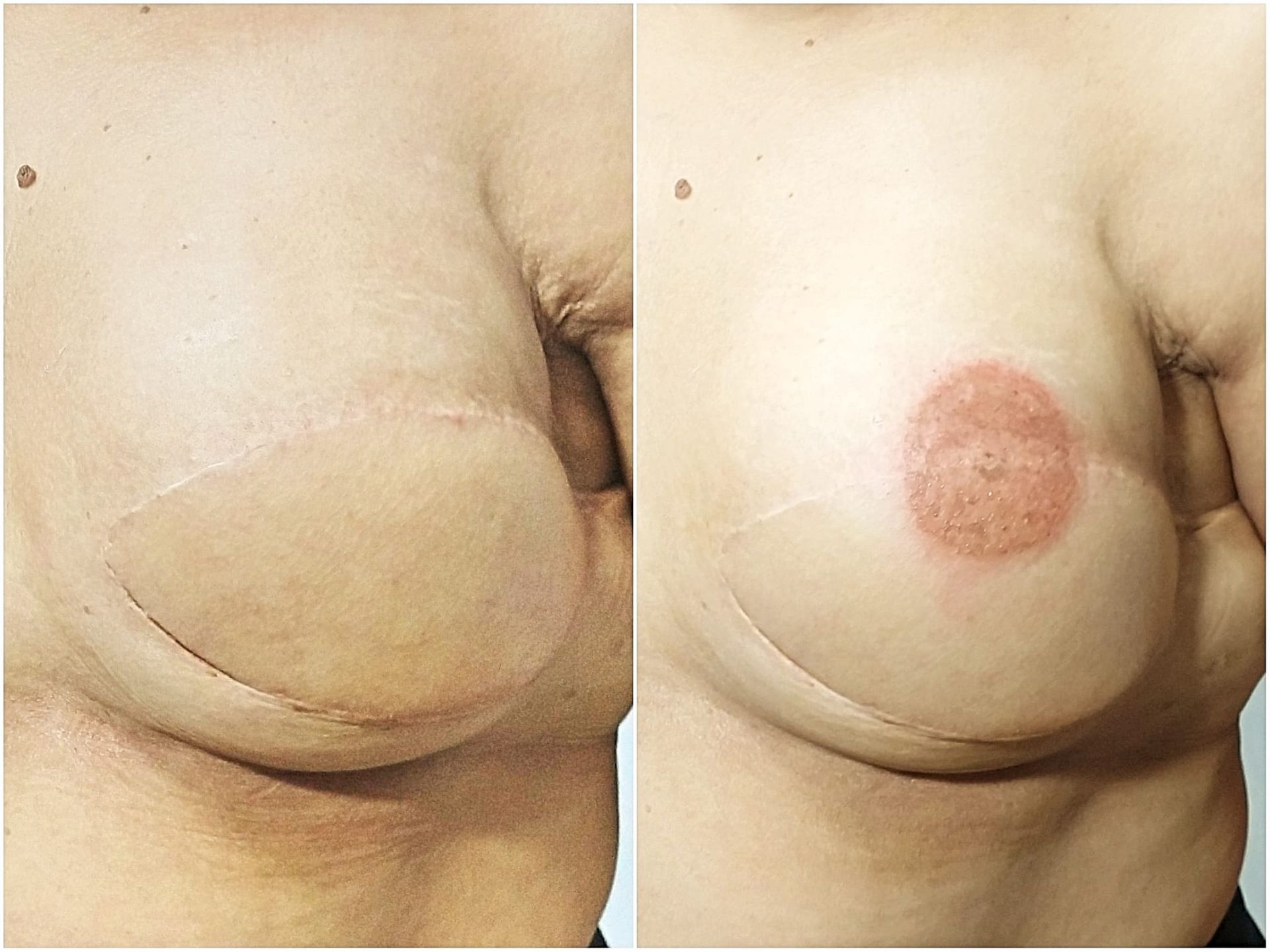 Reconstruction des Aréoles - Melissa Medeiros - Mell Medeiros