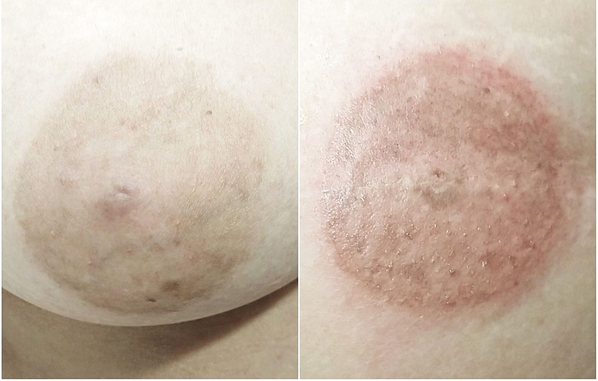 Reconstruction des Aréoles - Melissa Medeiros - Mell Medeiros