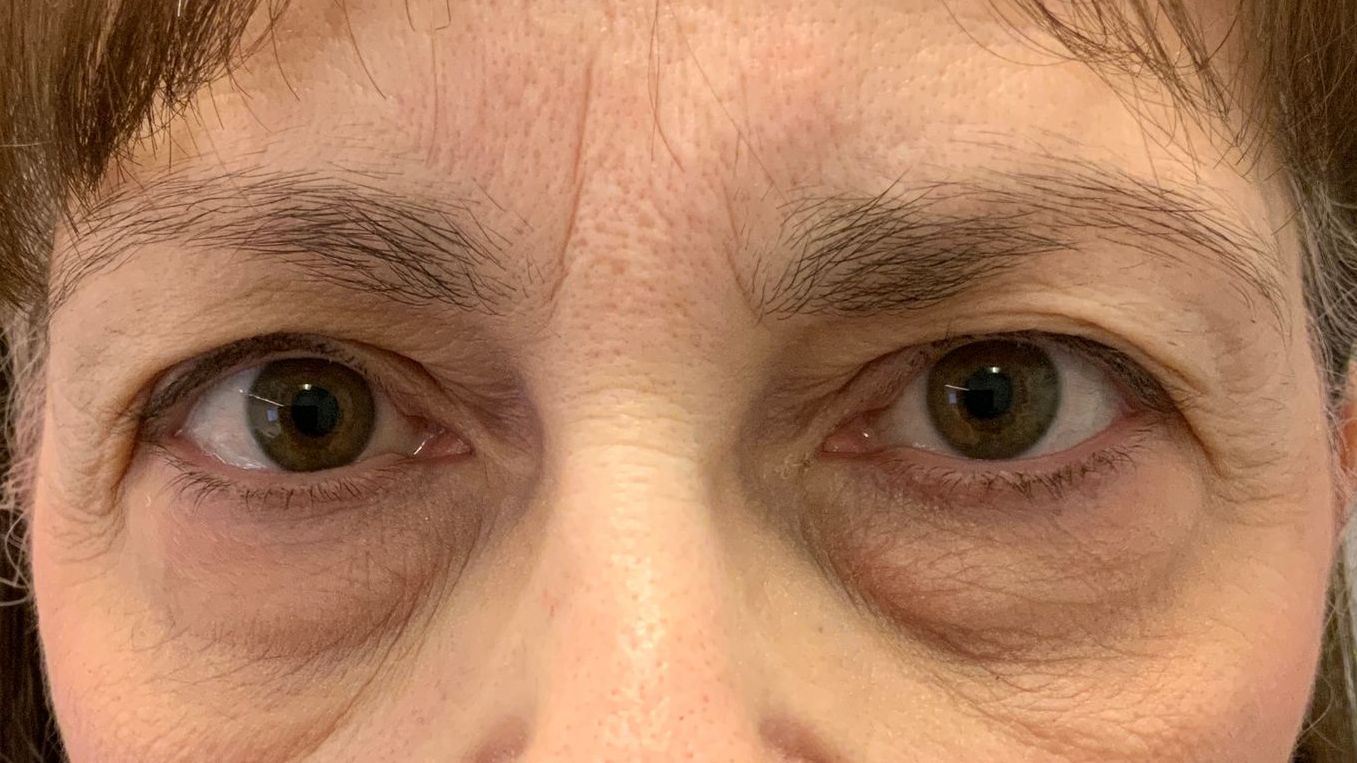 Chirurgie des 4 paupières