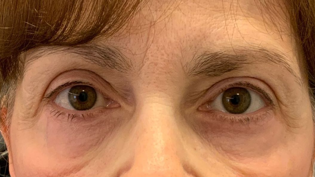 Chirurgie des 4 paupières