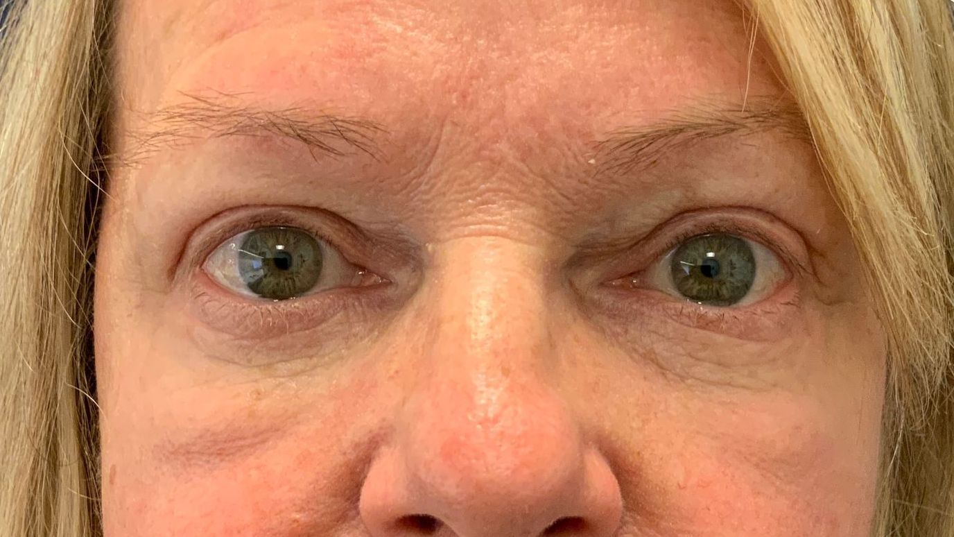 Chirurgie des 4 paupières