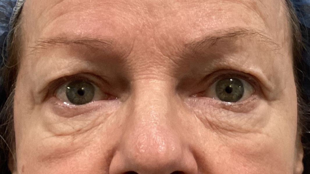 Chirurgie des 4 paupières