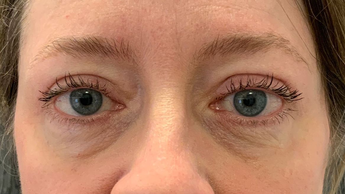 Chirurgie des paupières supérieures