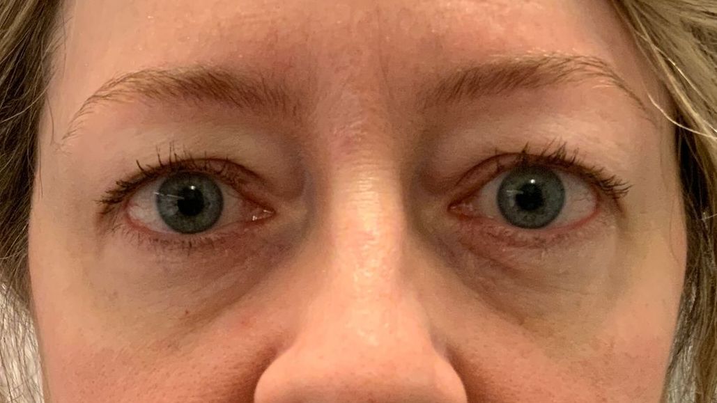 Chirurgie des paupières supérieures