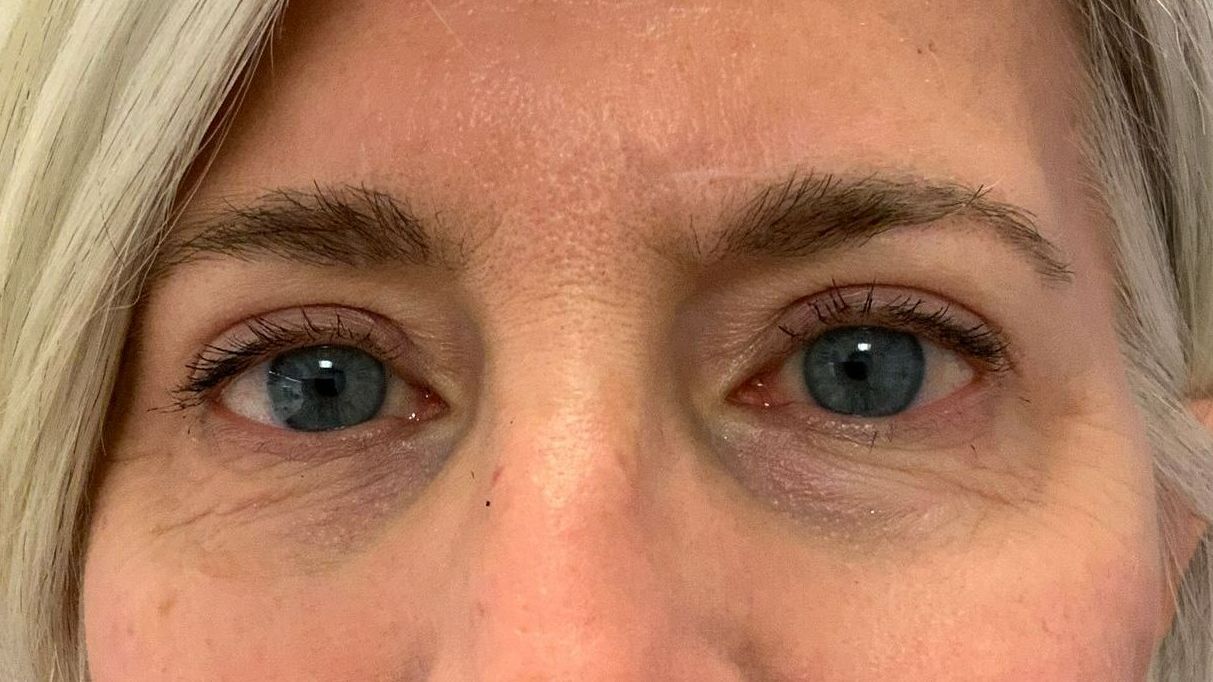 Chirurgie des paupières supérieures