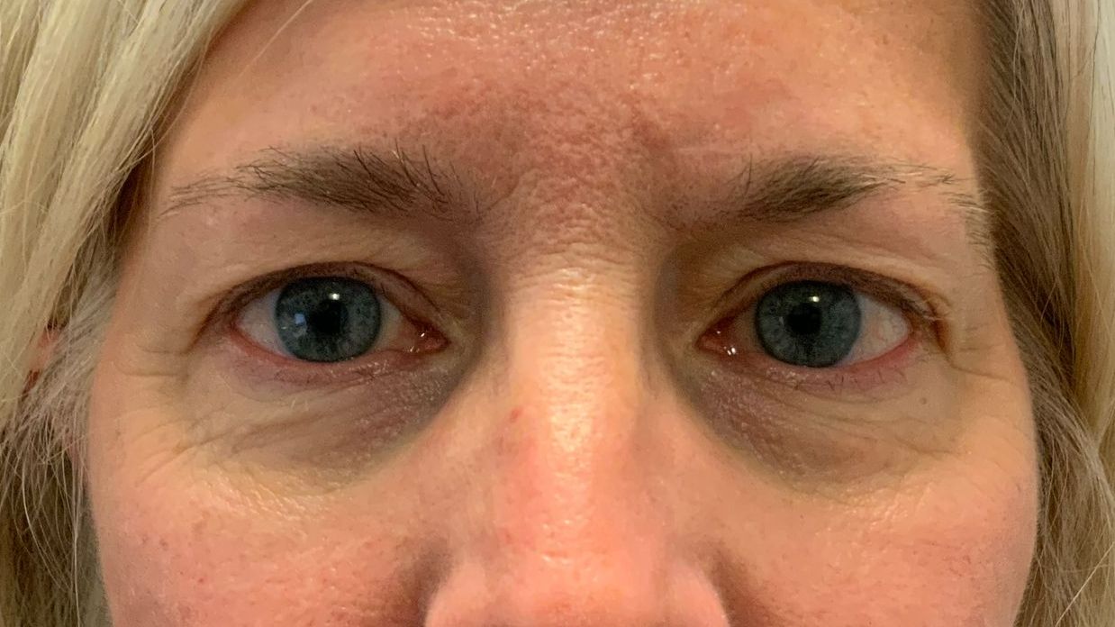 Chirurgie des paupières supérieures