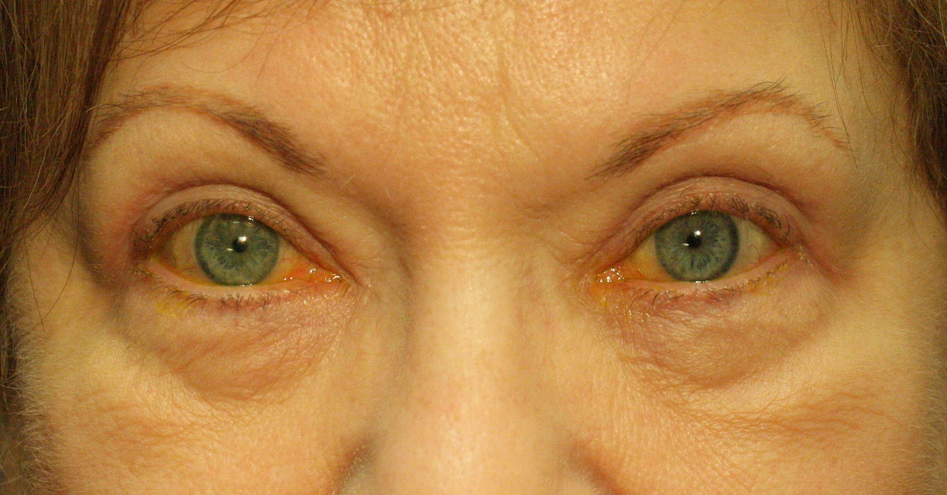 Chirurgie des paupières supérieures