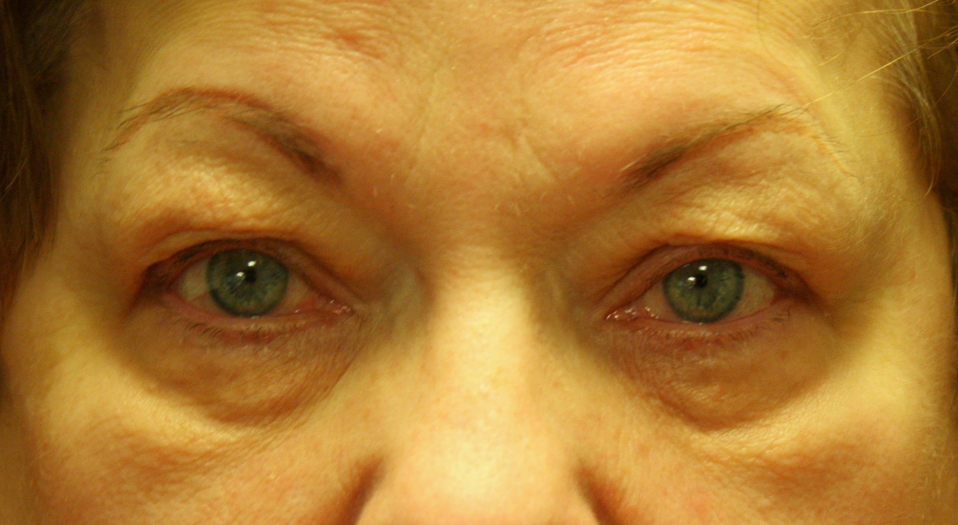 Chirurgie des paupières supérieures