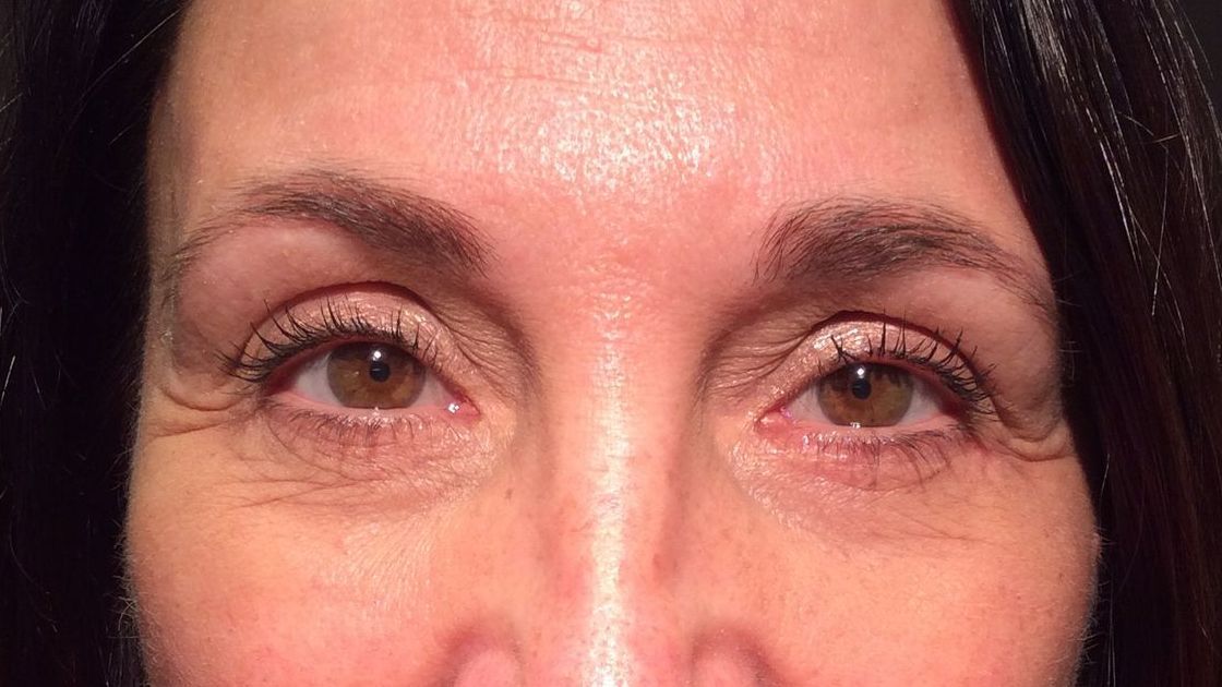 Chirurgie des paupieres inferieures