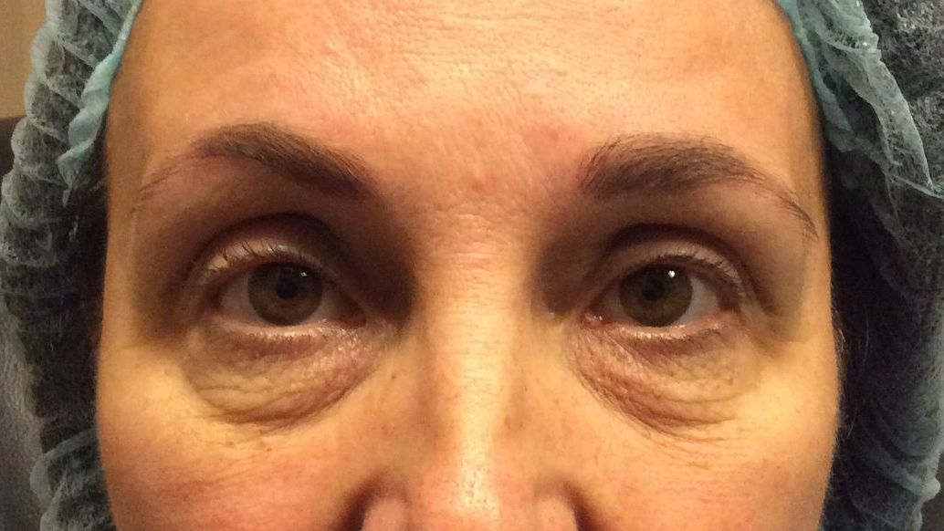 Chirurgie des paupieres inferieures