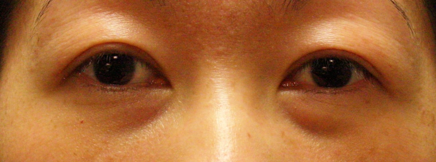 Chirurgie des paupieres asiatiques