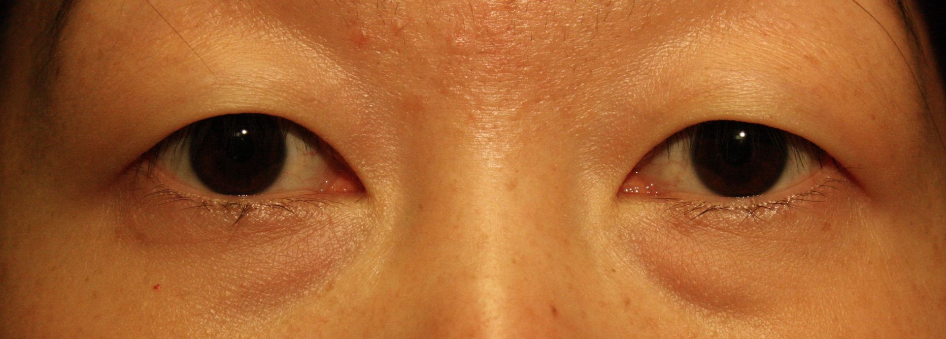 Chirurgie des paupieres asiatiques