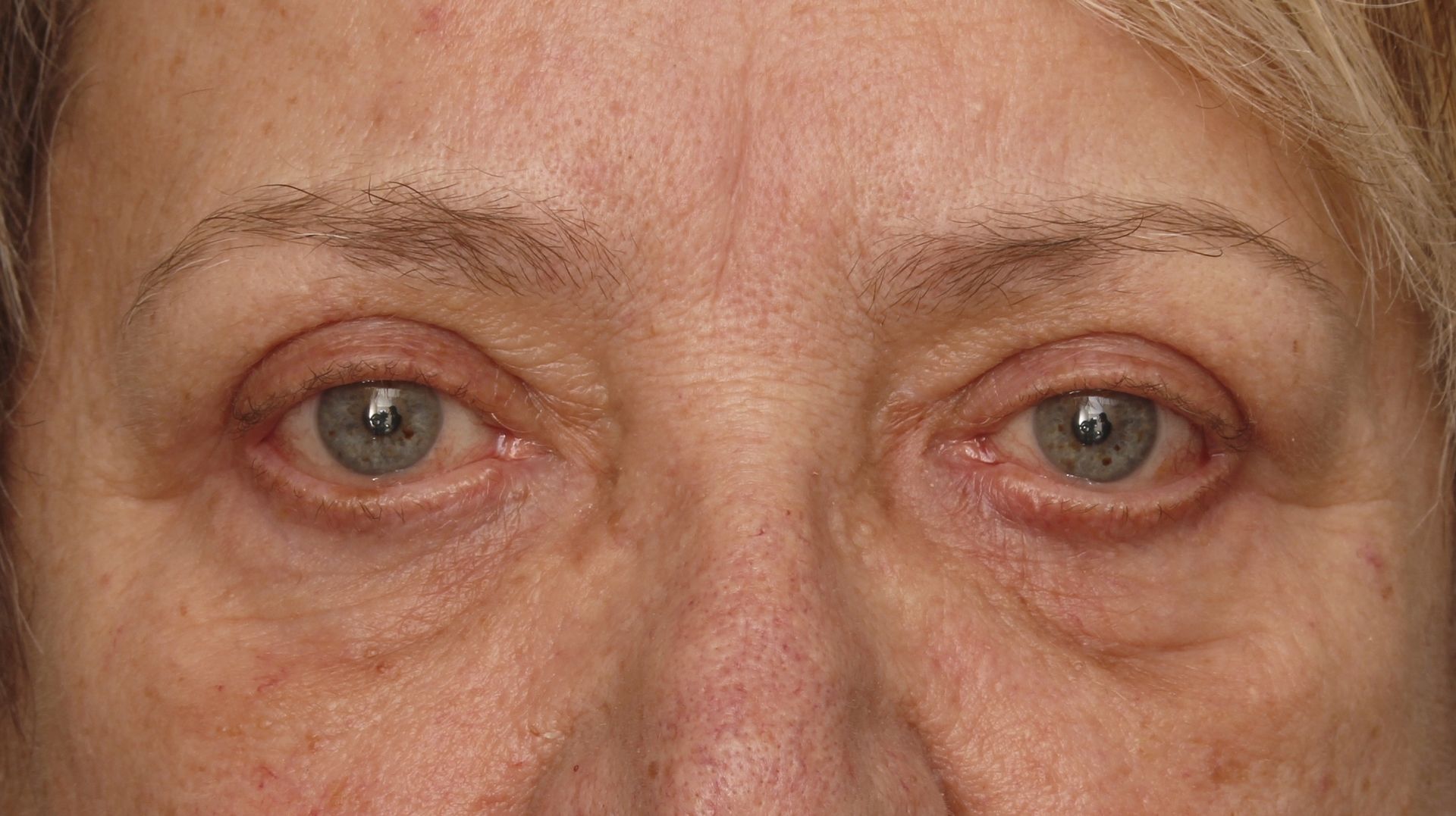 Chirurgie des 4 paupières