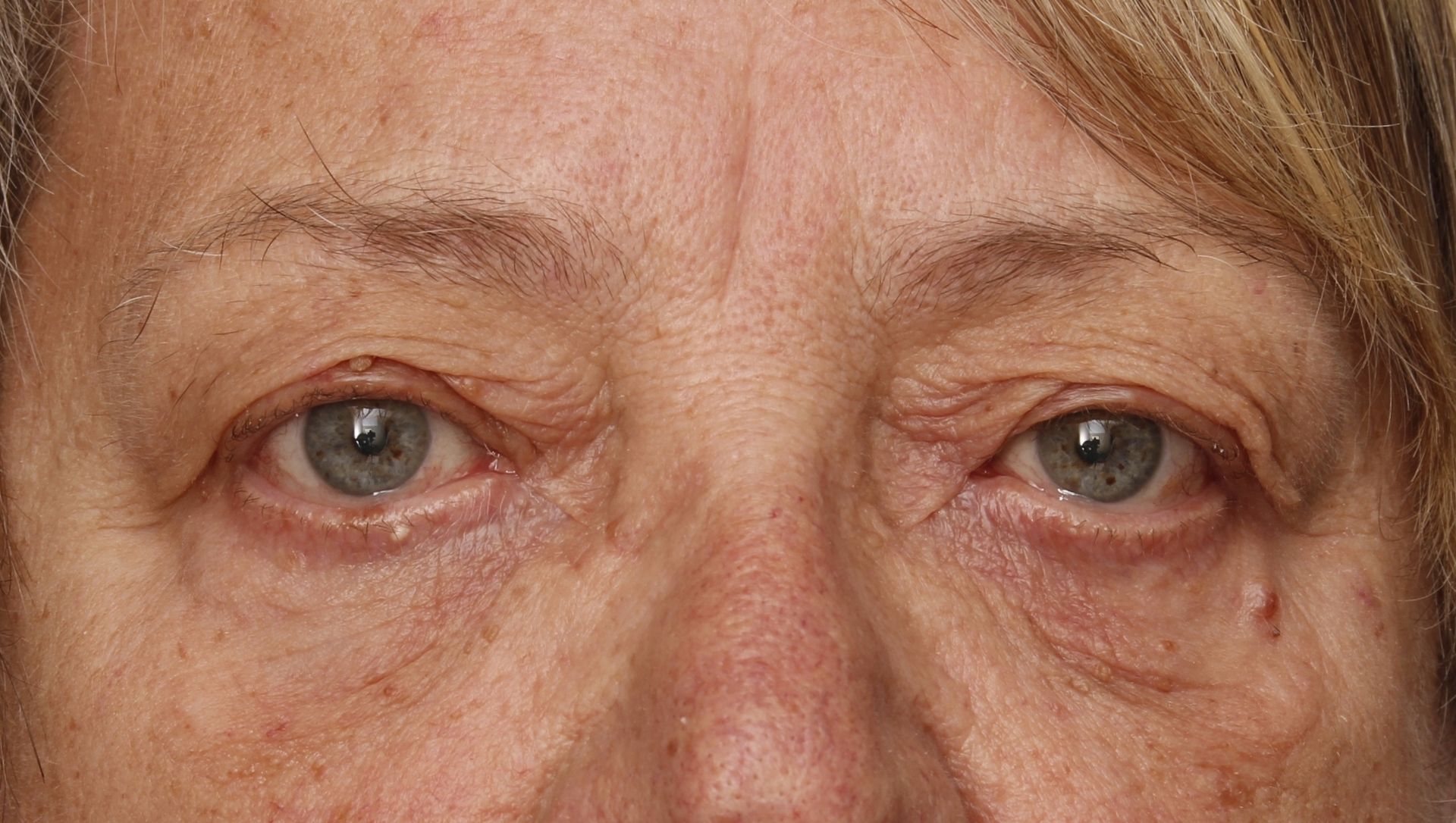 Chirurgie des 4 paupières