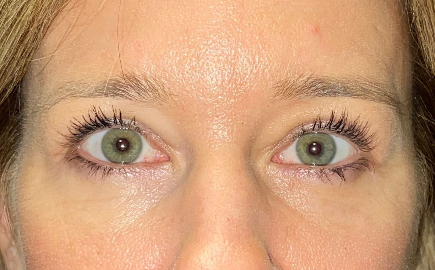 Chirurgie des 4 paupières