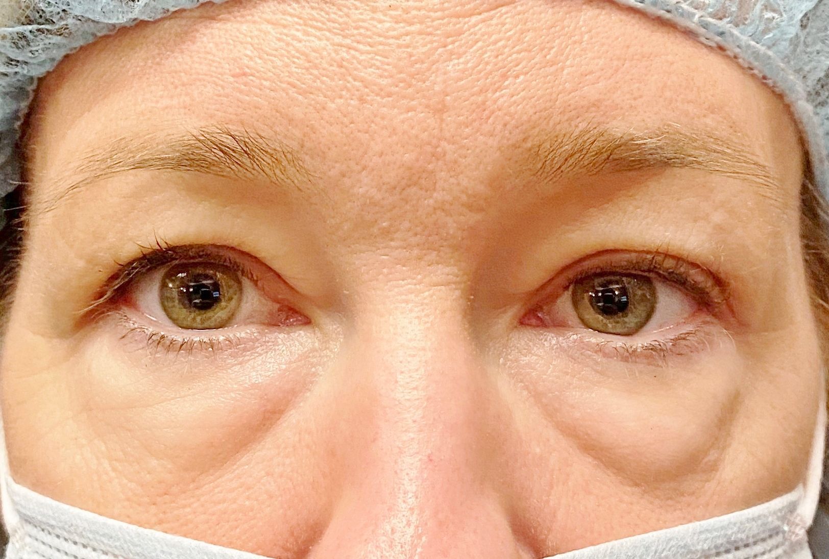 Chirurgie des 4 paupières