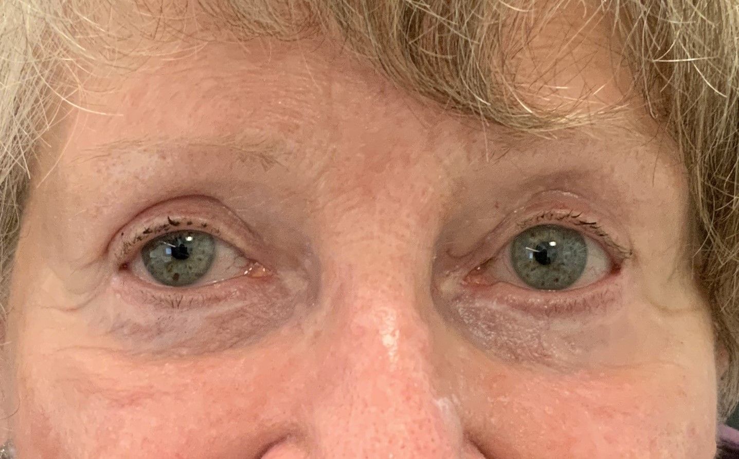 Chirurgie des 4 paupières